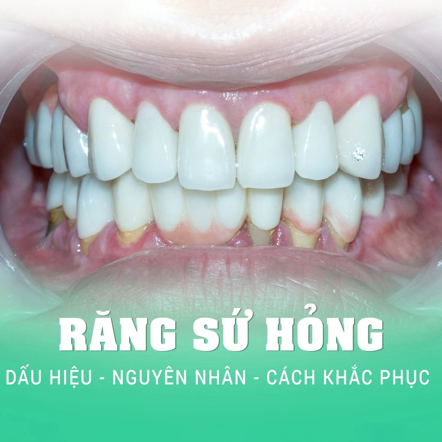 Cảnh Báo "Đỏ": Đừng Để Mất Trắng Răng Thật Chỉ Vì Bọc Răng Sứ Hỏng! (Dấu Hiệu & Cách Cứu Vãn)